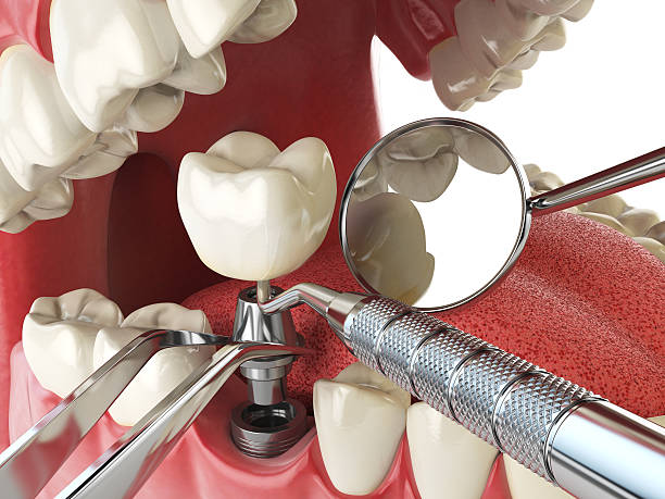 Best Broken or Cracked Tooth Emergency Dentist in Prattville, AL